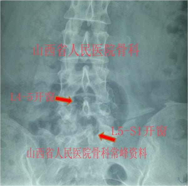 复发性腰椎间盘突出症可以行椎间孔镜微创手术