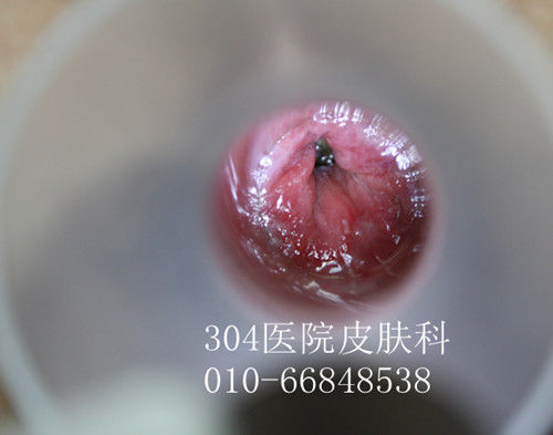 儿童肛管内尖锐湿疣治疗前后(高清图---22)