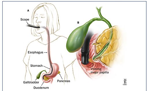 壶腹癌,壶腹周围癌