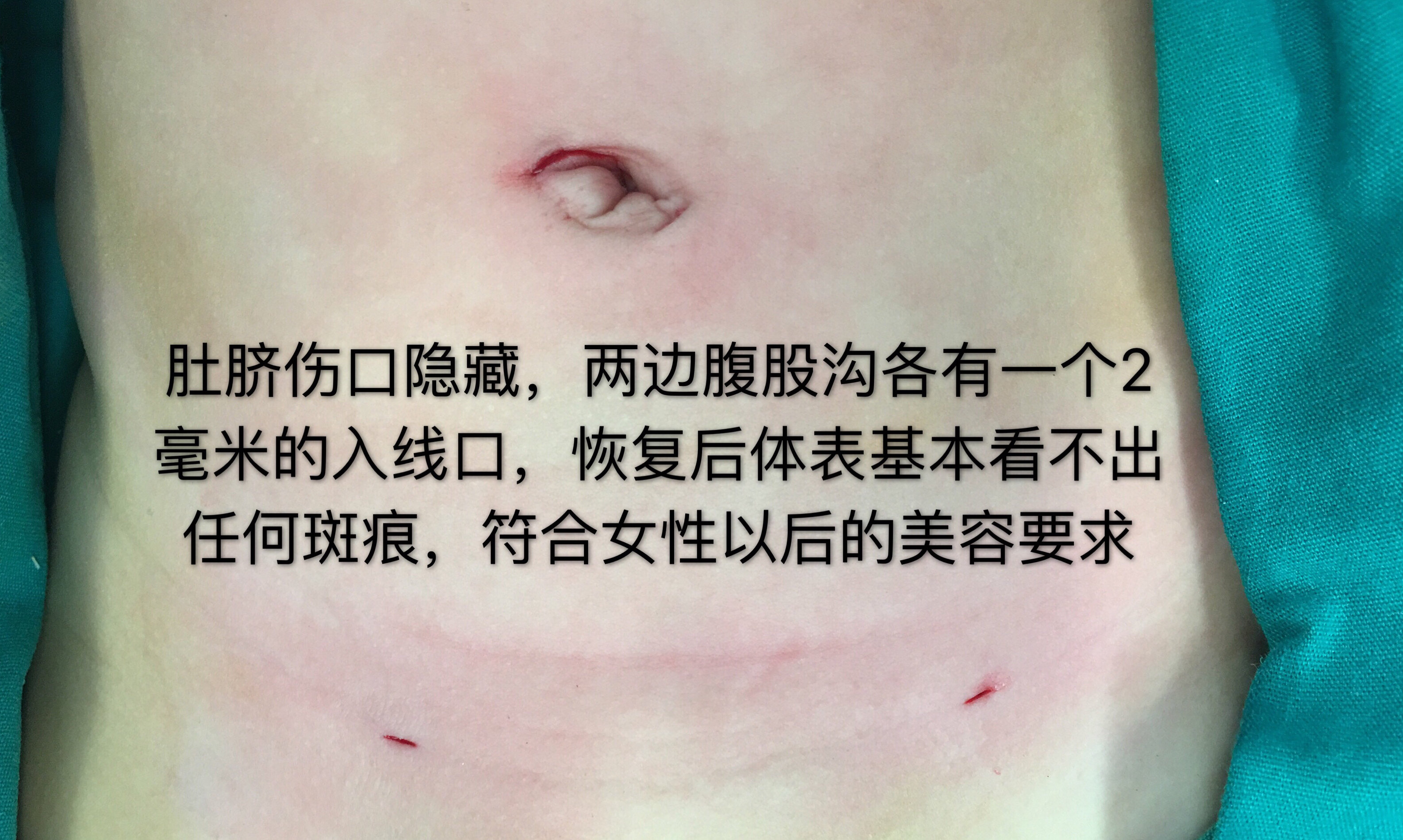 一分钟看图了解女孩子腹股沟斜疝腹腔镜微创手术
