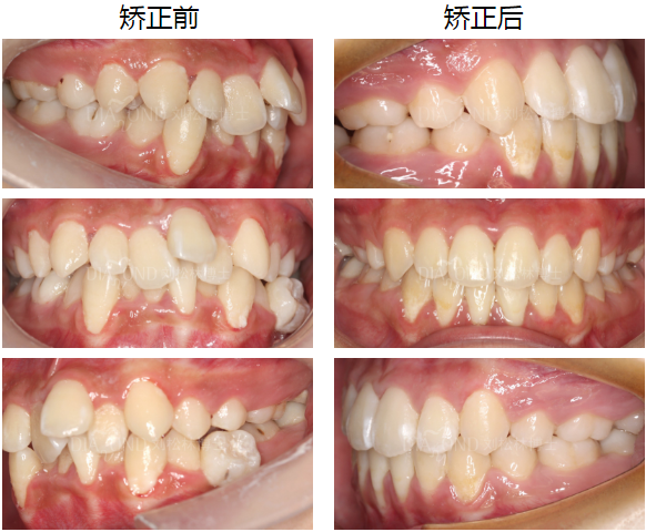 丑小鸭的华丽蜕变牙齿前突拥挤的拔牙矫正