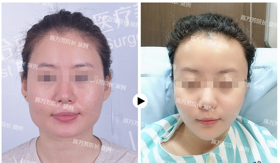 06 下巴吸脂后要注意什么 陈万芳院长:主要注意以下四个方面