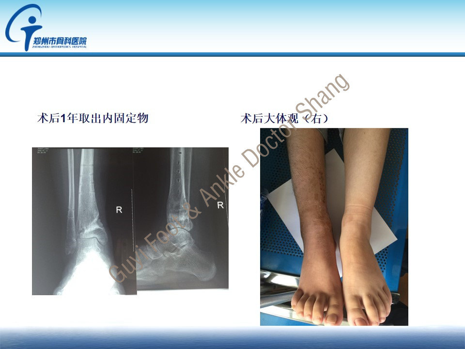 踝上截骨治疗内翻型踝关节炎