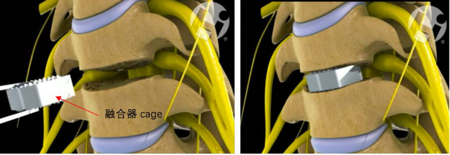 安装椎间融合器