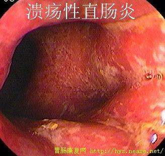 结肠镜图谱