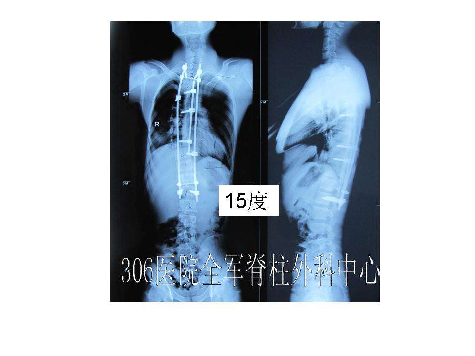脊柱侧弯典型病例17例成人僵硬型脊柱侧弯男23岁65度