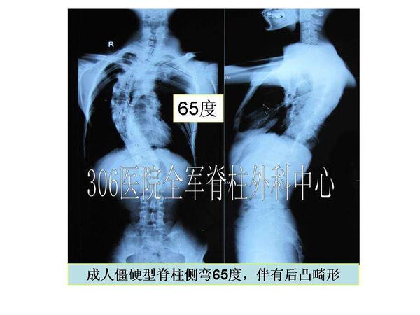 脊柱侧弯典型病例17例成人僵硬型脊柱侧弯男23岁65度