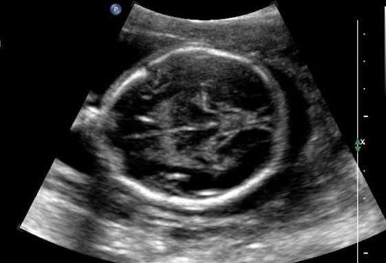 胎儿正常超声表现