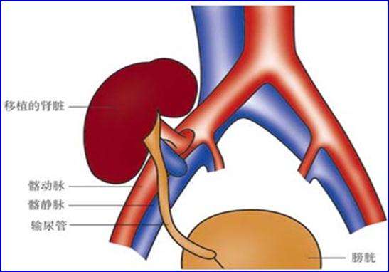 肾移植怎么做?(图解肾移植)