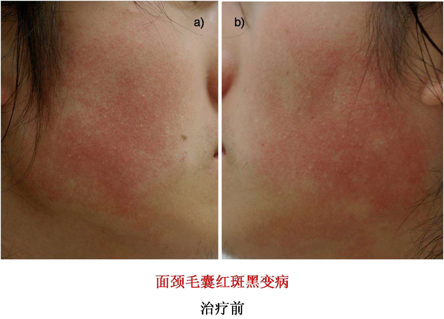 面颈毛囊红斑黑变病 (赤红面,红脸膛)