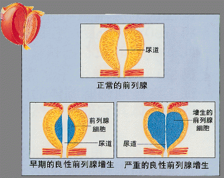 前列腺增生科普知识