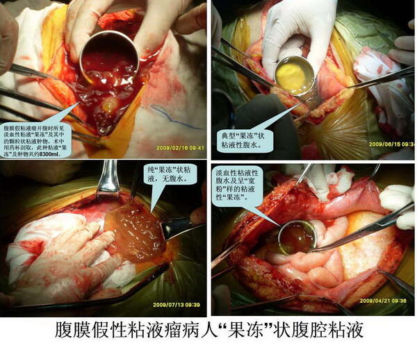 腹膜假性粘液瘤腔镜下及手术中所见