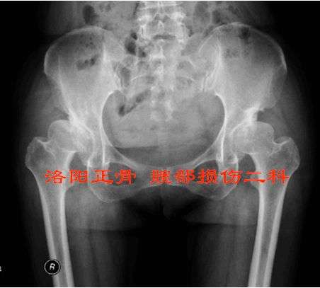 股骨头坏死晚期,髋关节发育不良,强脊炎髋强直的根治性治疗.