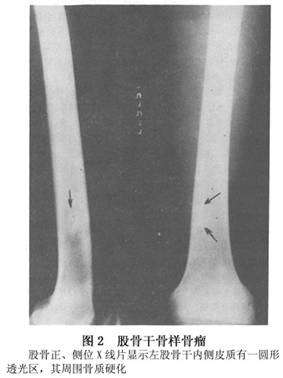 骨样骨瘤 osteoid osteoma