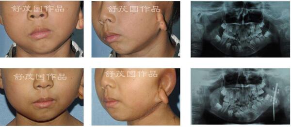半侧颜面萎缩(第一二腮弓综合征)牵引成骨治疗