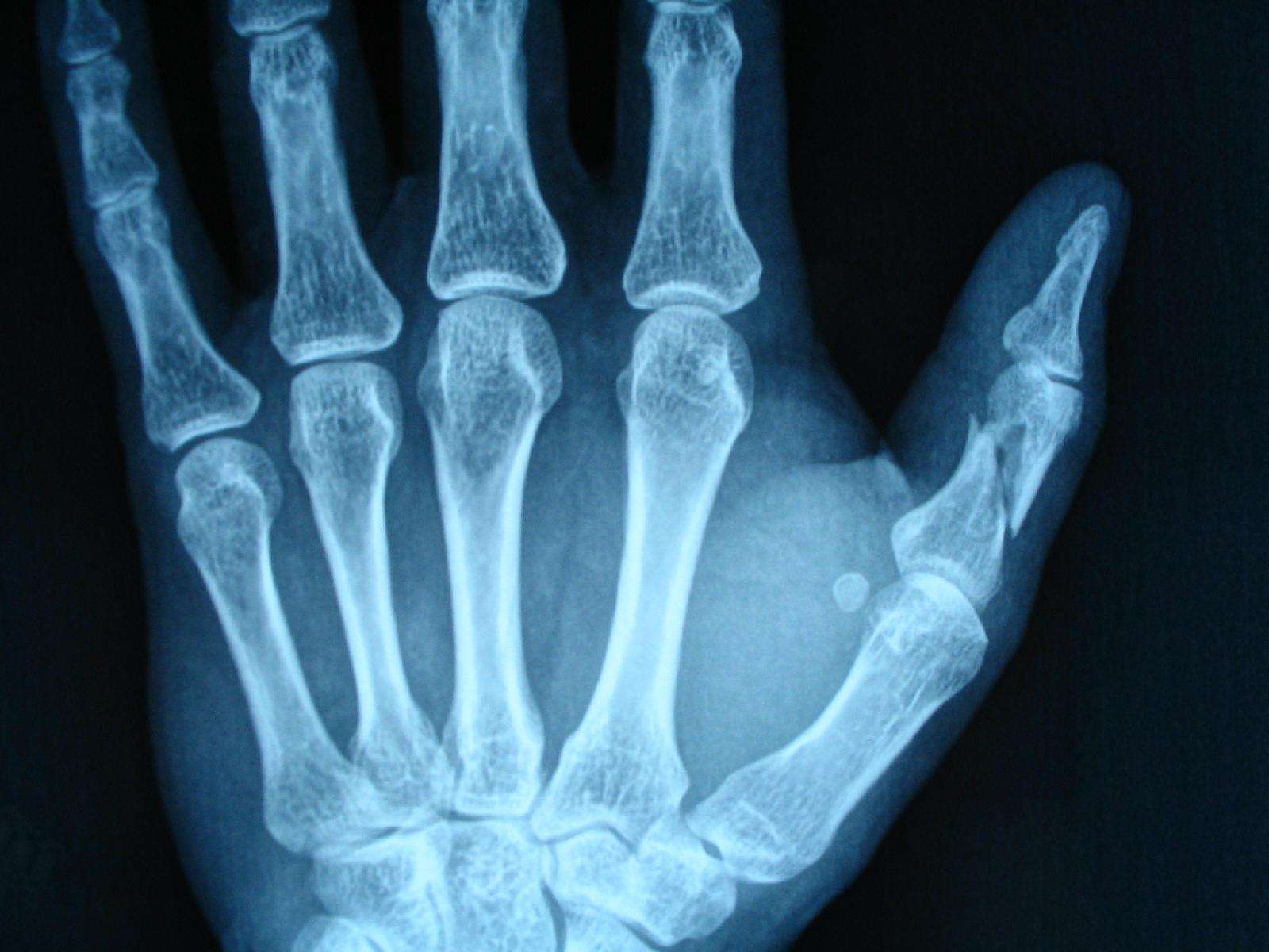 见拇指近节呈 粉碎性骨折 ,一大的斜形骨折线将拇指