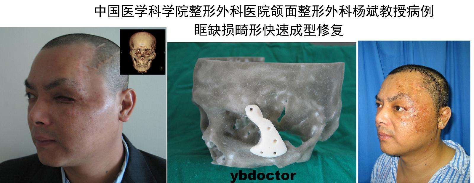 颅面骨缺损的快速成型修复技术