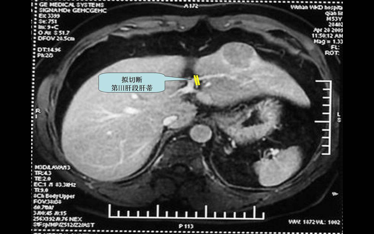 肝蒂横断法:在实施肝癌切除时,摒弃以往切开glisson鞘分别切断门静脉