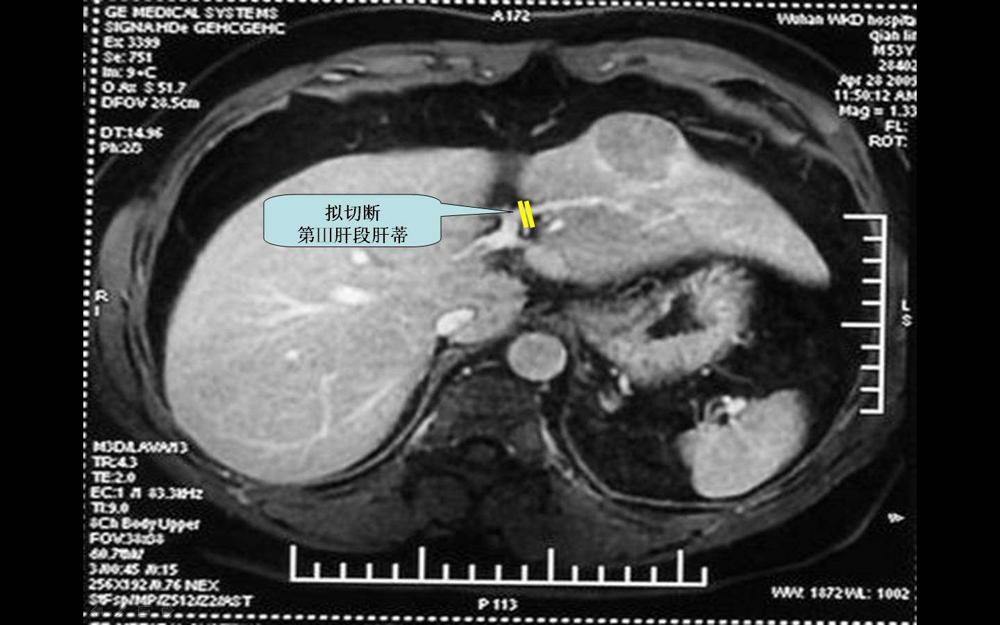 单肝段切除范例 s3 段肝癌切除,作者手术图片资料)例一 患者ct