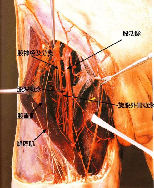 经股神经与股血管间隙的股骨小粗隆手术入路
