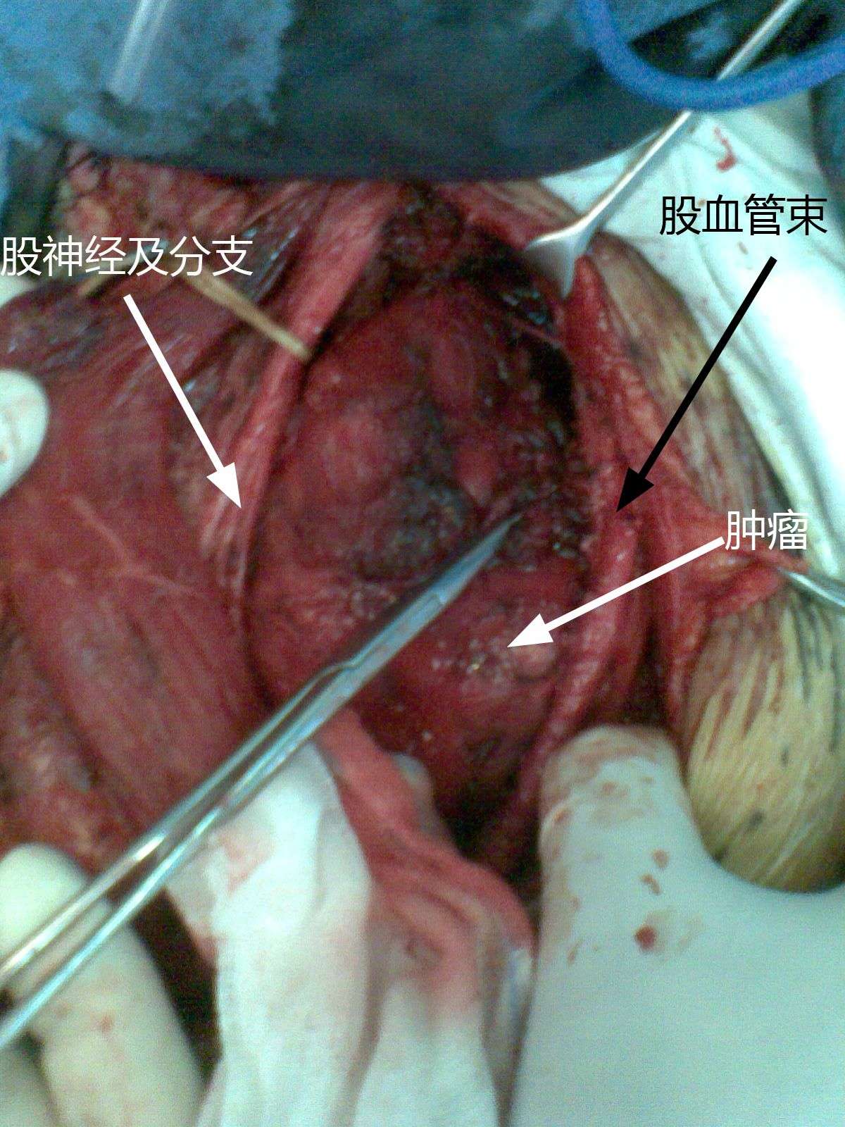 经股神经与股血管间隙的股骨小粗隆手术入路