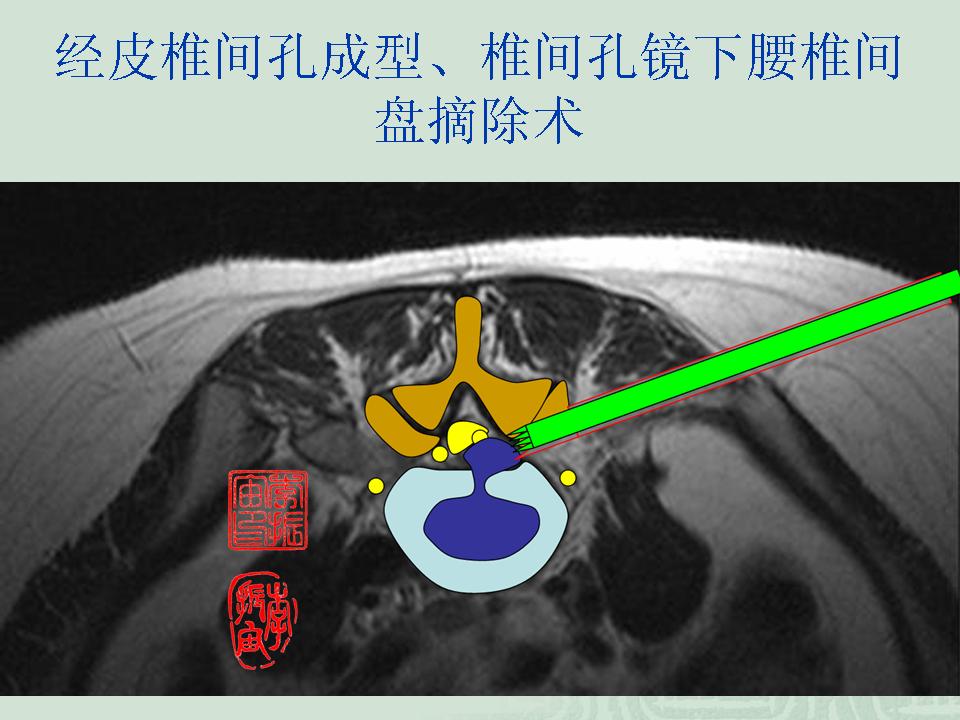 经皮腰椎间孔成型经椎间孔内镜下腰椎间盘摘除术治疗非包含型腰椎间盘