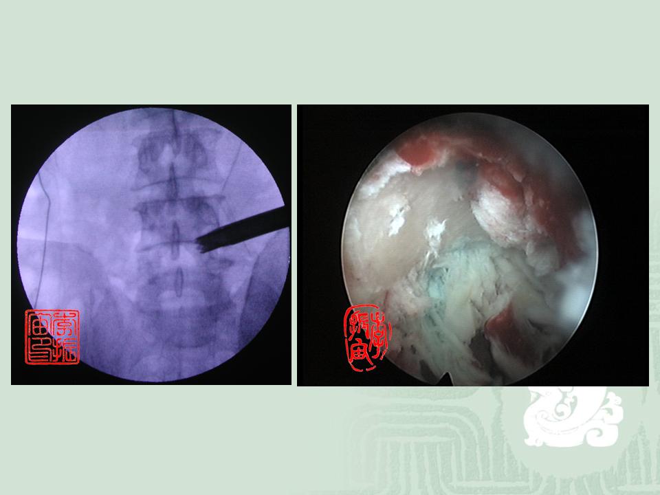 经皮腰椎间孔成型术治疗腰椎侧隐窝狭窄症