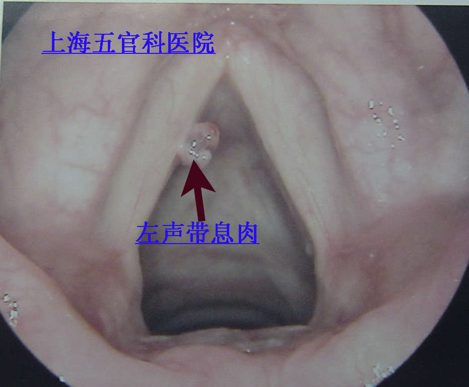 要手术治疗的声带息肉图片