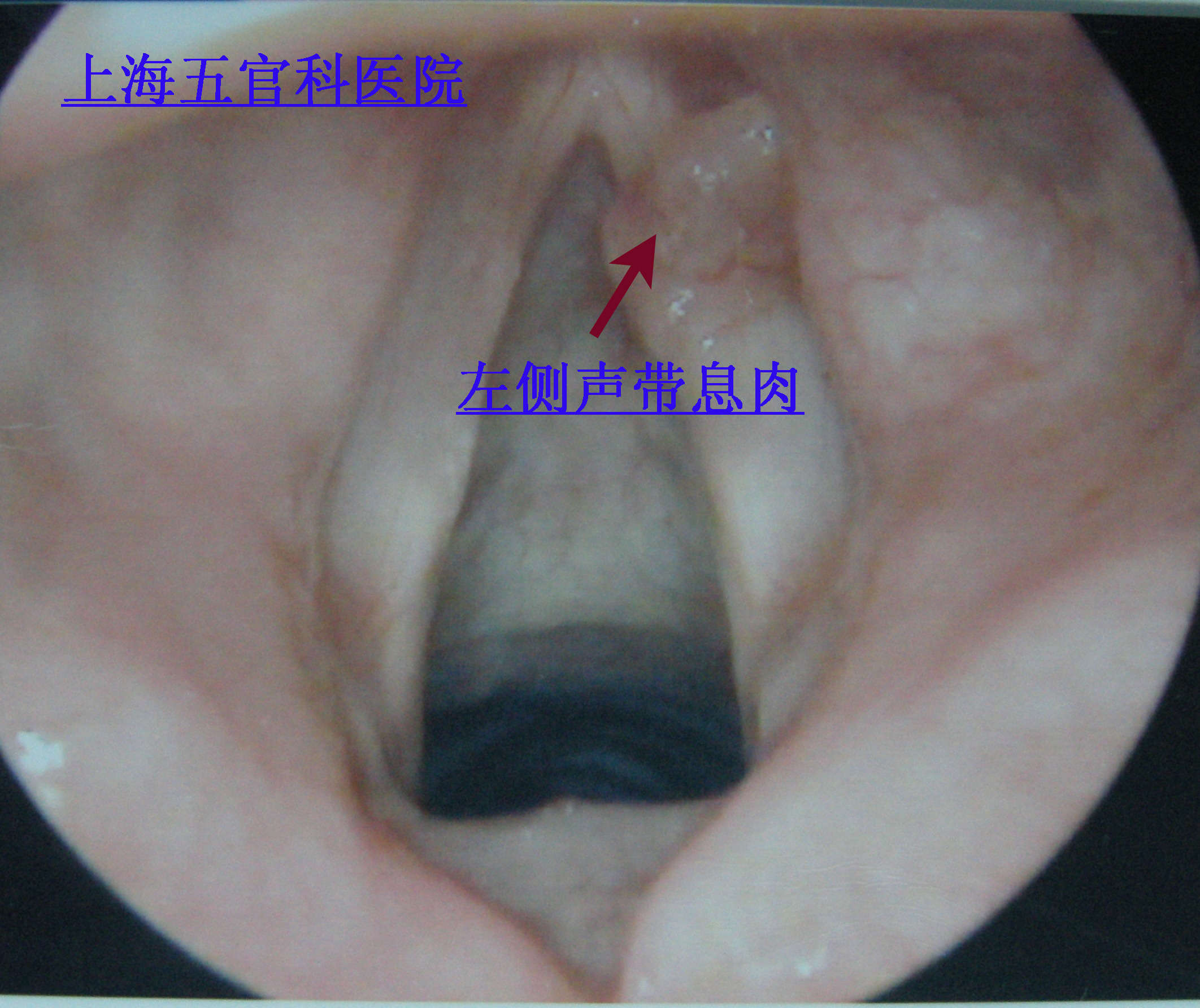 要手术治疗的声带息肉图片_声带息肉