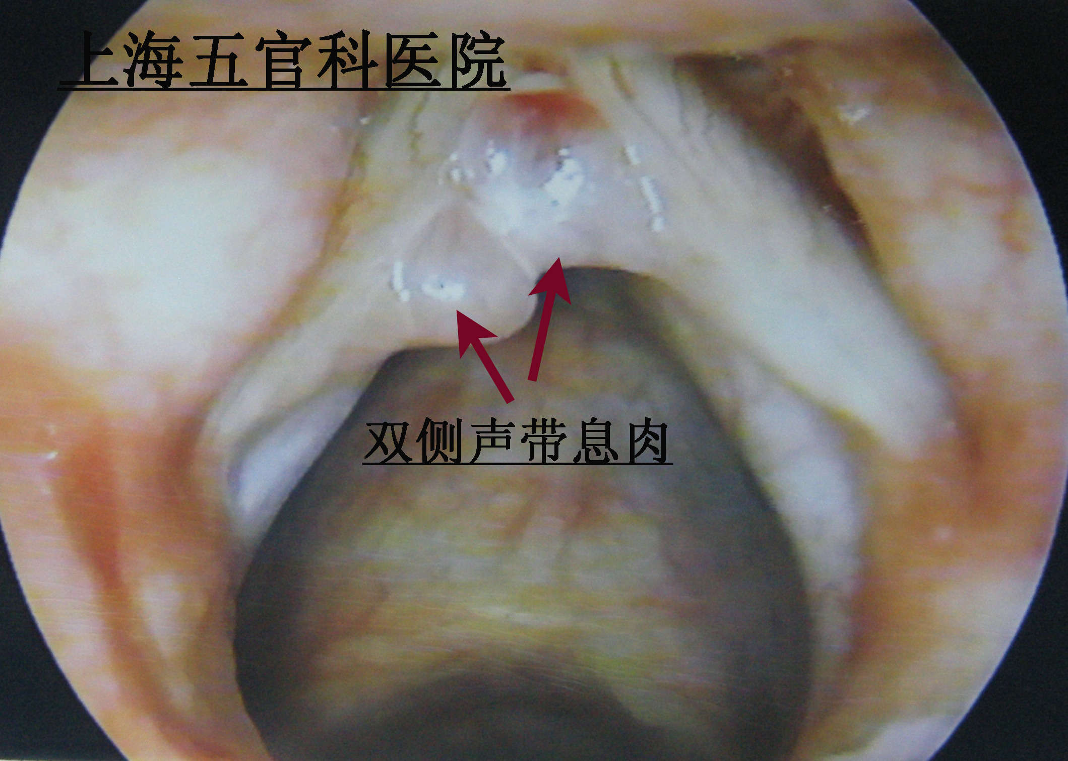 要手术治疗的声带息肉图片