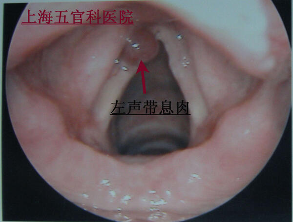 要手术治疗的声带息肉图片