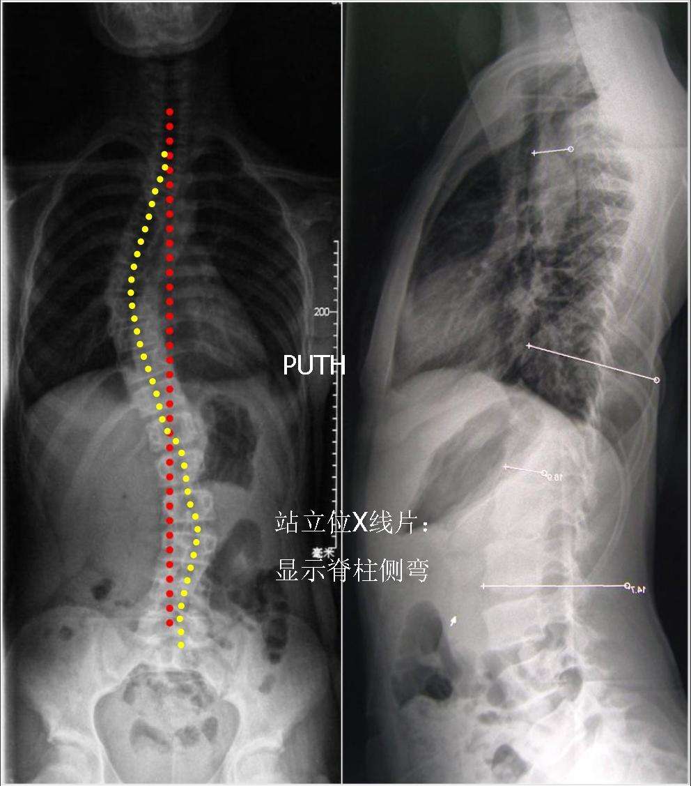 11岁女孩,发现脊柱侧弯4个月,侧弯迅速加重,两肩不等高