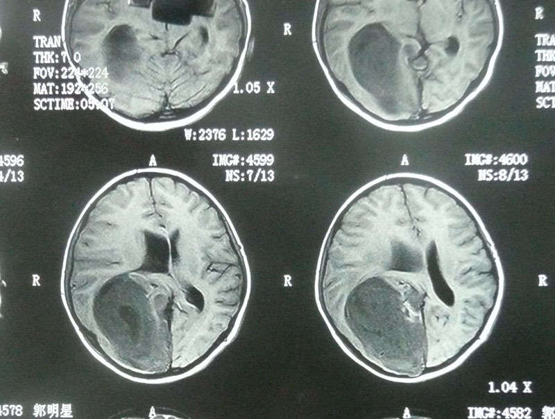 巨大胶质瘤术后复查(图组)