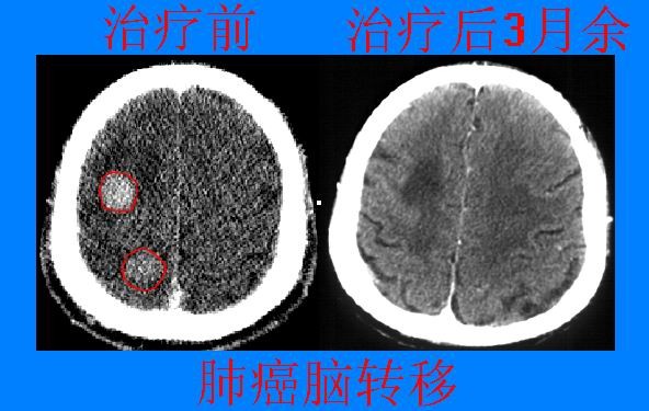 脑转移瘤大分割短疗程立体定向精确放射治疗