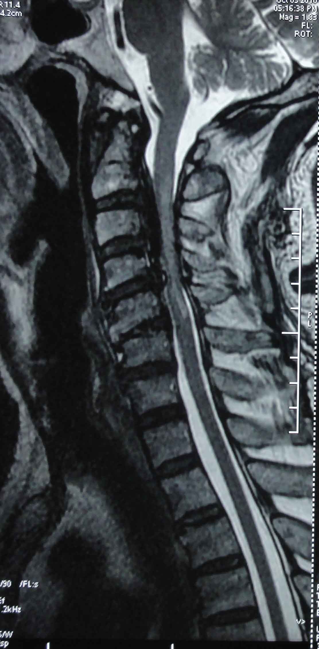 颈椎病/图1 患者颈椎CT显示后纵韧带钙化，颈椎管严重狭窄