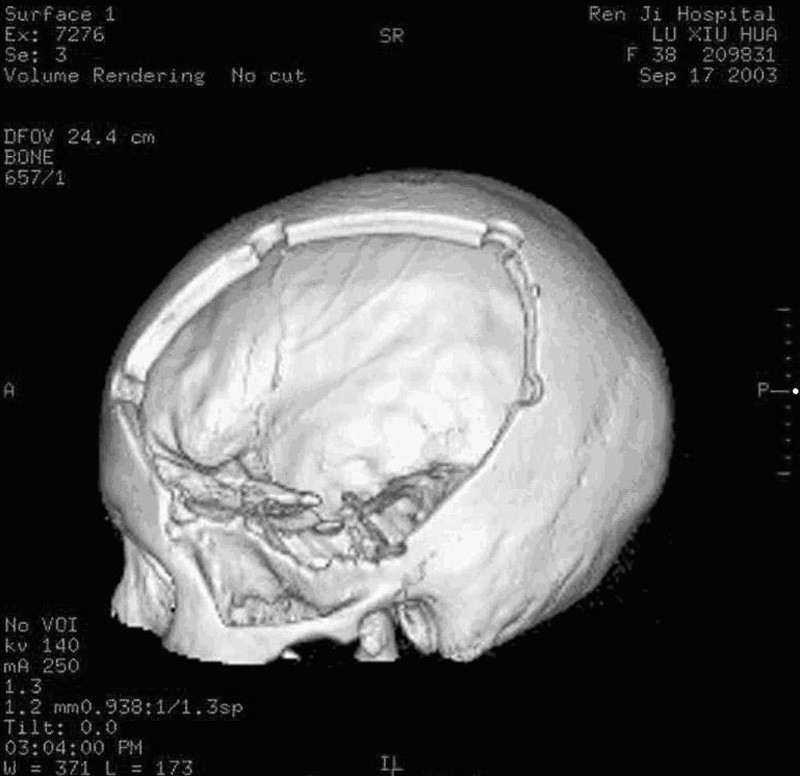 左侧标准外伤大骨瓣术后颅骨三维ct像