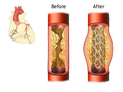 冠状动脉粥样硬化及支架的示意图