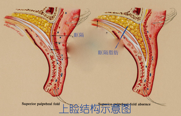 上眼皮凹陷怎么办