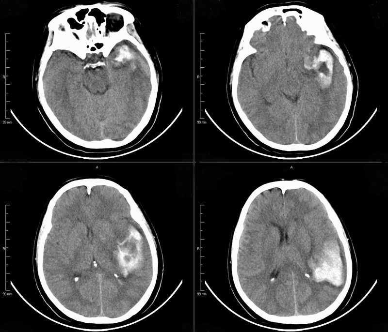 对于以脑血管意外表现起病者,即使在首次ct上仅仅表现为颞叶或额叶ich