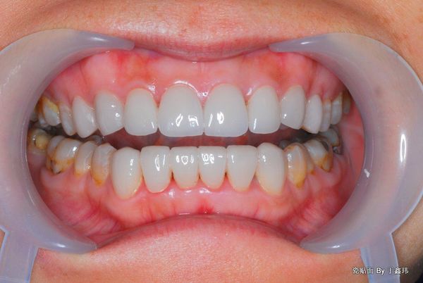 全瓷贴面 美学修复 四环素牙!