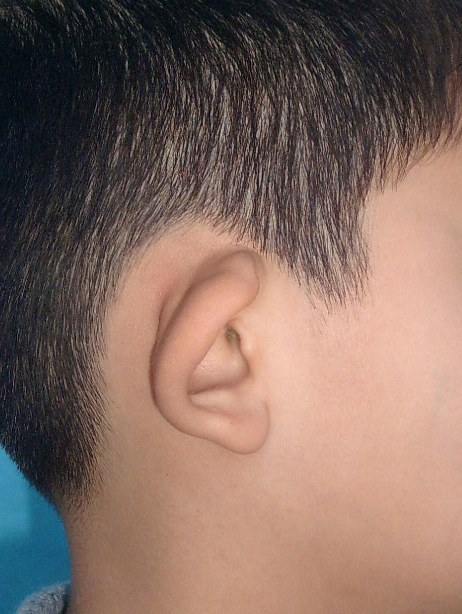 各式各样的耳廓畸形-杯状耳