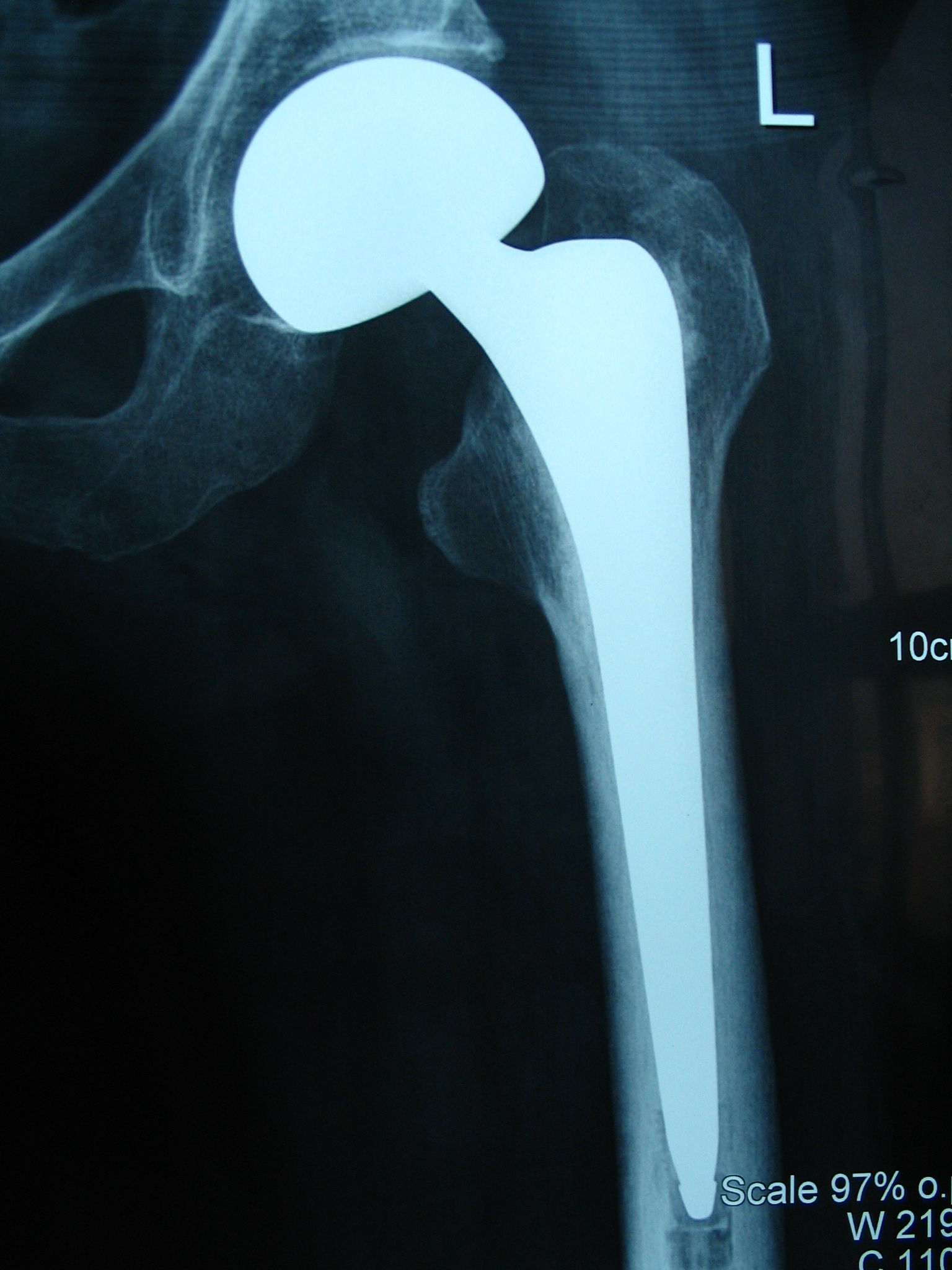 (图片)人工股骨头置换治疗老年股骨颈骨折