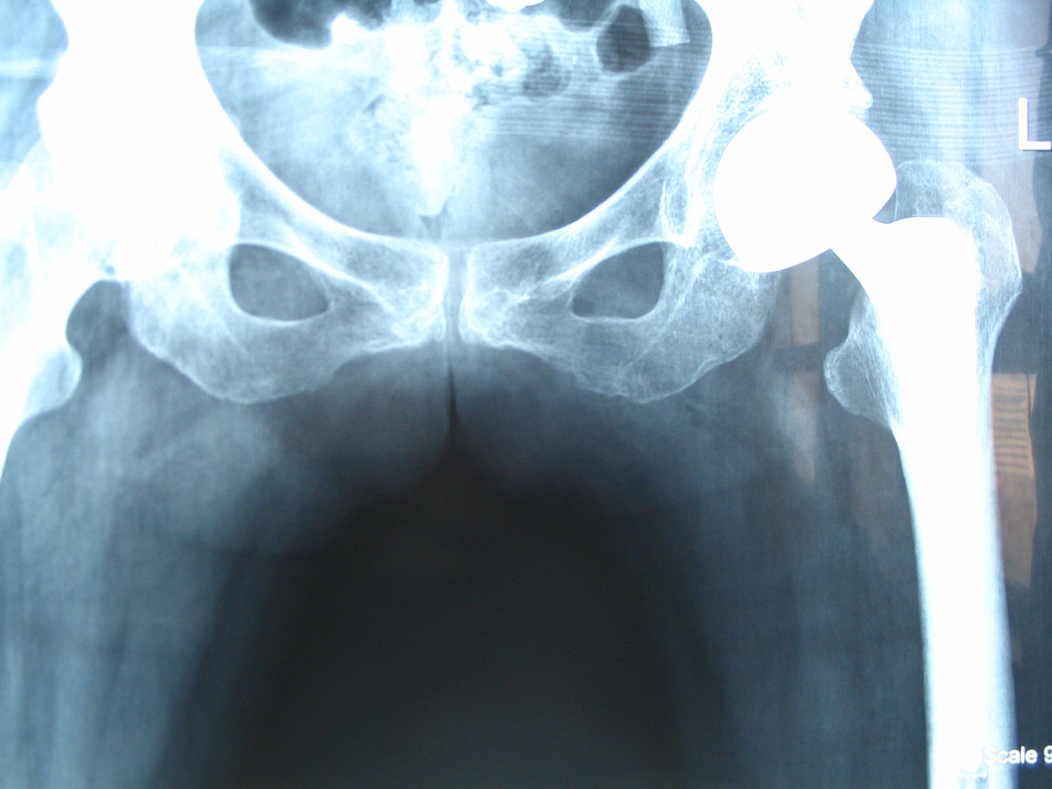 图片人工股骨头置换治疗老年股骨颈骨折