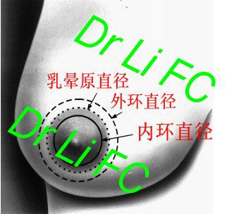 乳房缩小术(四):双环法乳房缩小术(periareolar breast reduction)