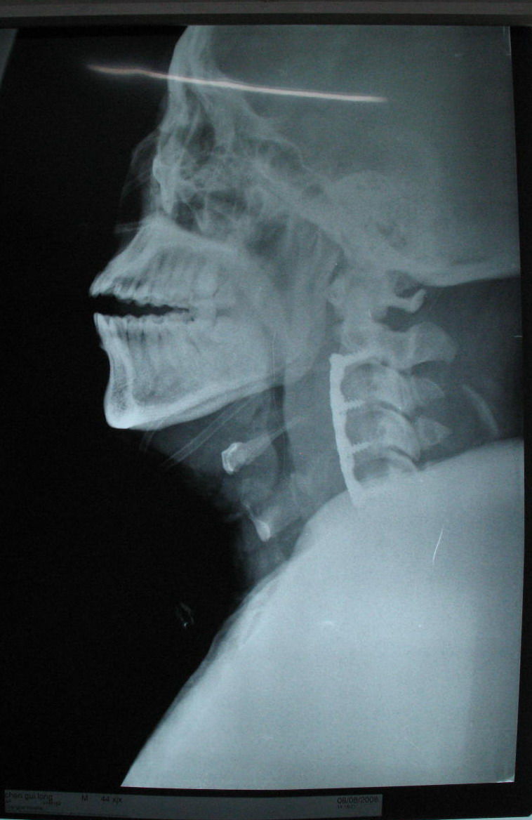 颈椎后纵韧带骨化症