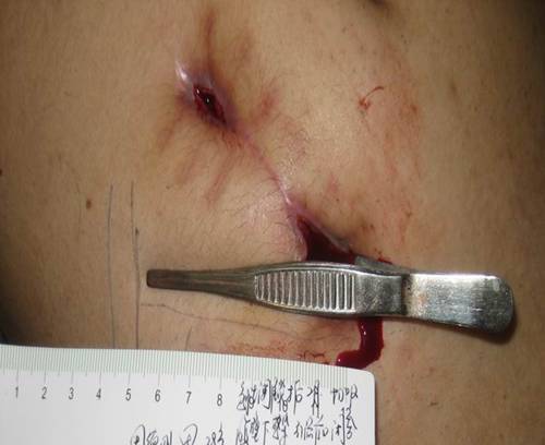 治愈1例急性阑尾炎切除术后窦道形成和腹壁下感染伤口患者