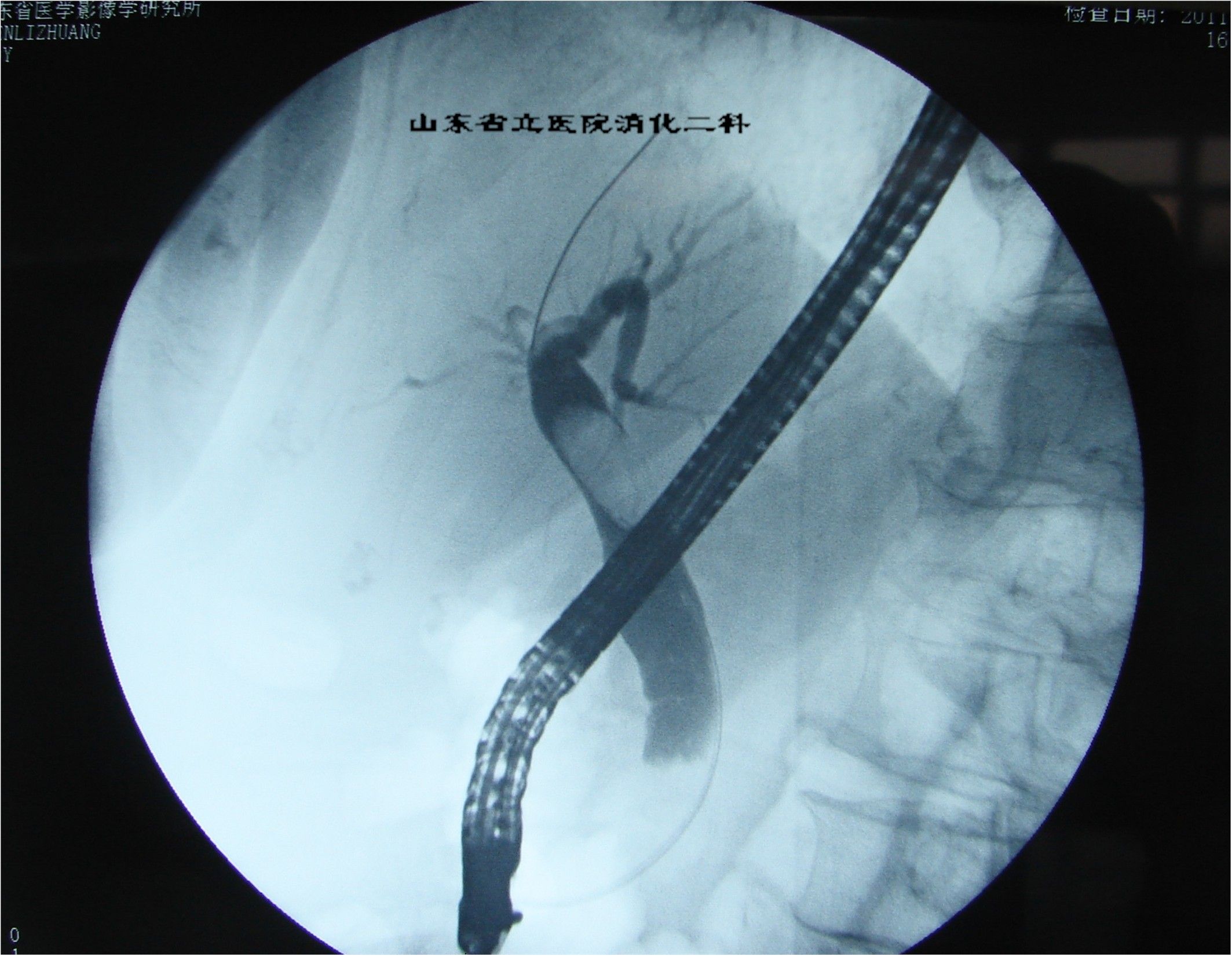 胆总管巨大结石ercp内镜介入微创治疗