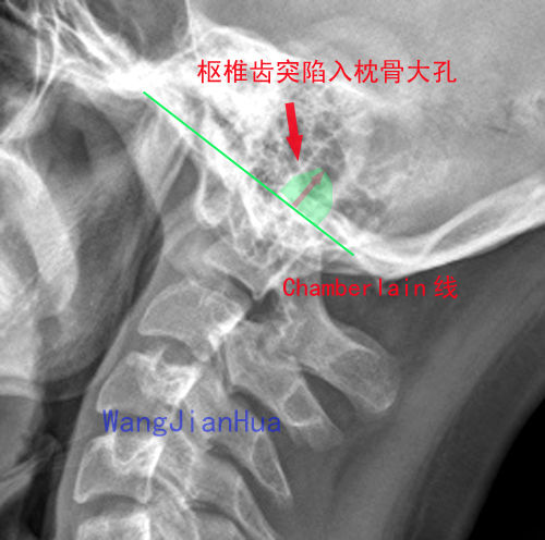 术前x片显示,患者的枢椎齿状突明显高过颚枕线,向上突入枕骨大孔