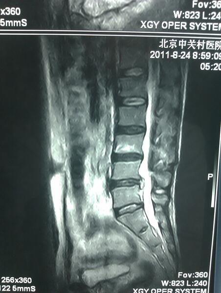 典型病例:椎间孔镜手术治疗巨大腰椎间盘突出