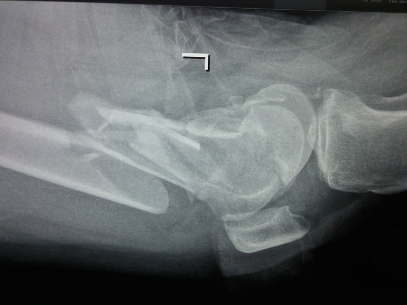 (图片)股骨髁上粉碎性骨折